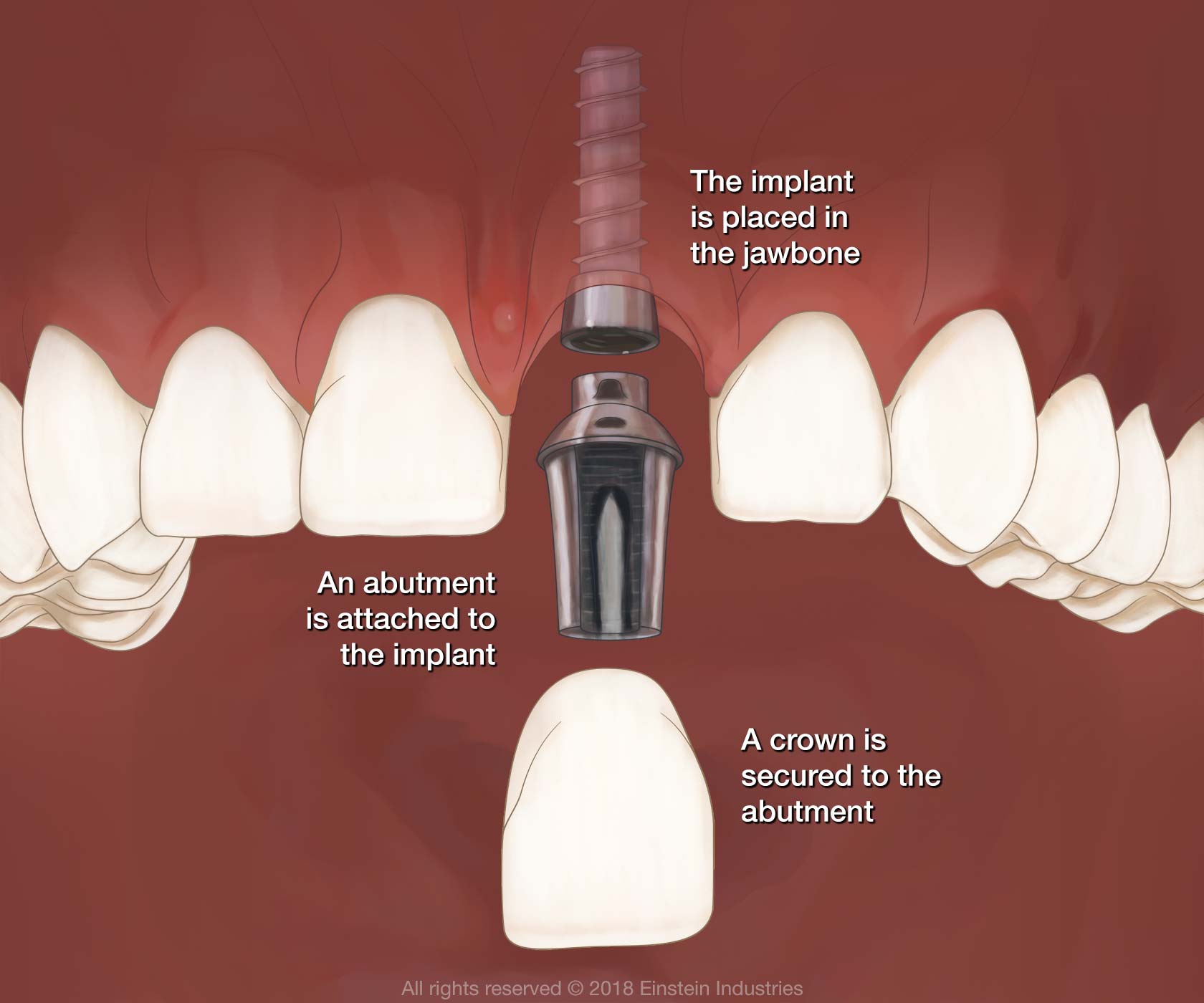 an implant, abutment, and dental crown